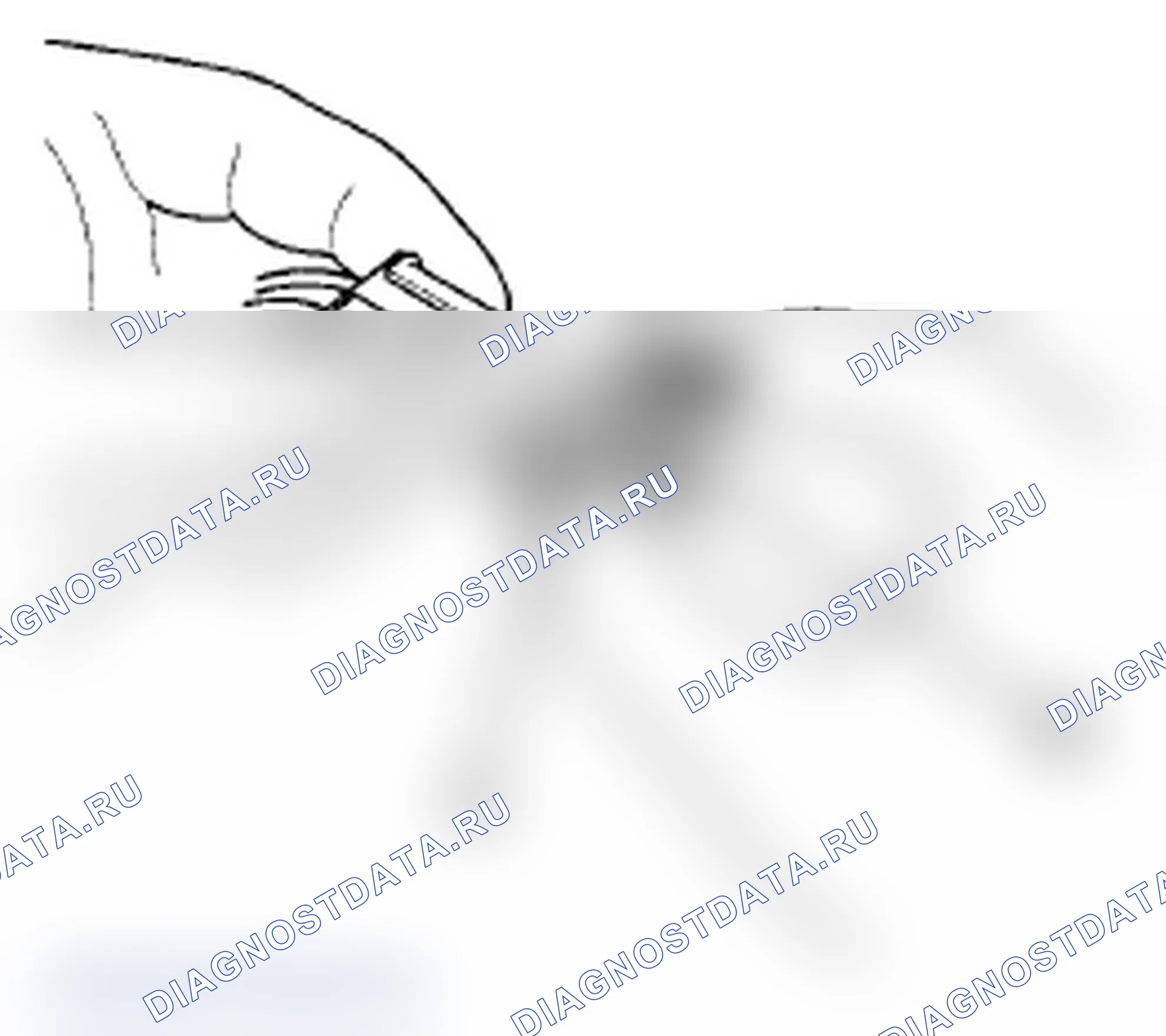 Рис. 19: Разъединение. Acura TL IV рестайлинг