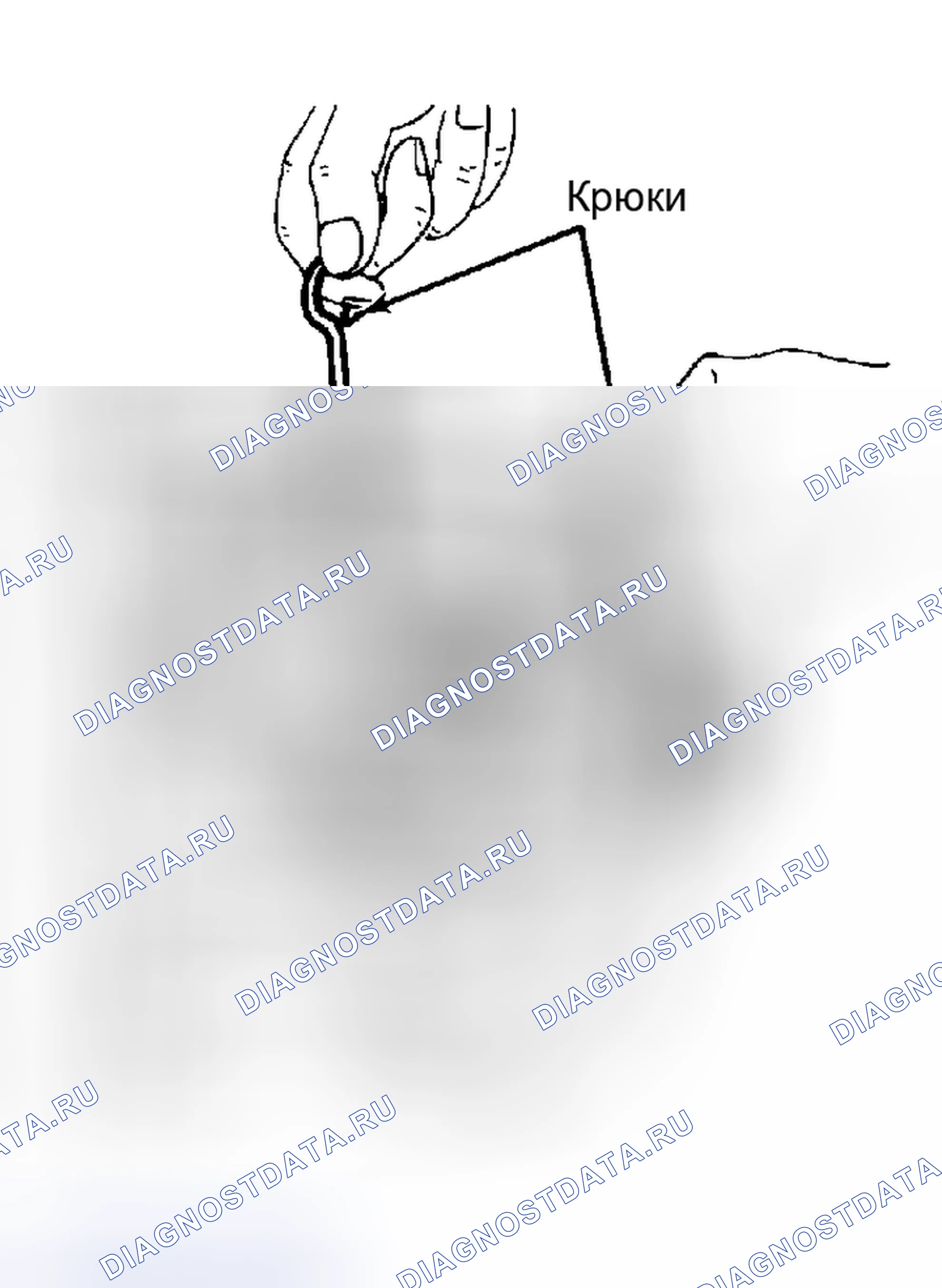 Рис. 12: Извлечение одностороннего сцепления из корпуса. Volkswagen Golf Mk1