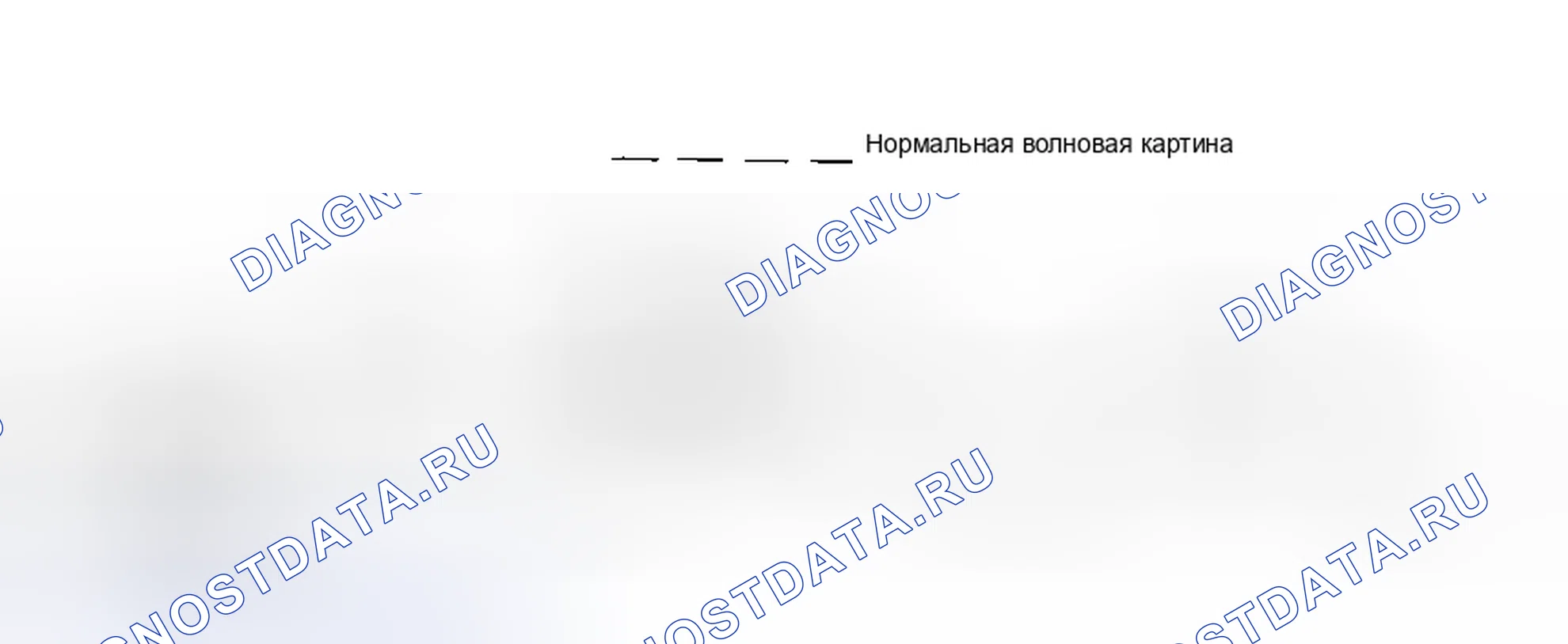 Рис. 69: КОДЫ 44, 52 и 53: КАТУШКИ ЗАЖИГАНИЯ. Honda CR-X III