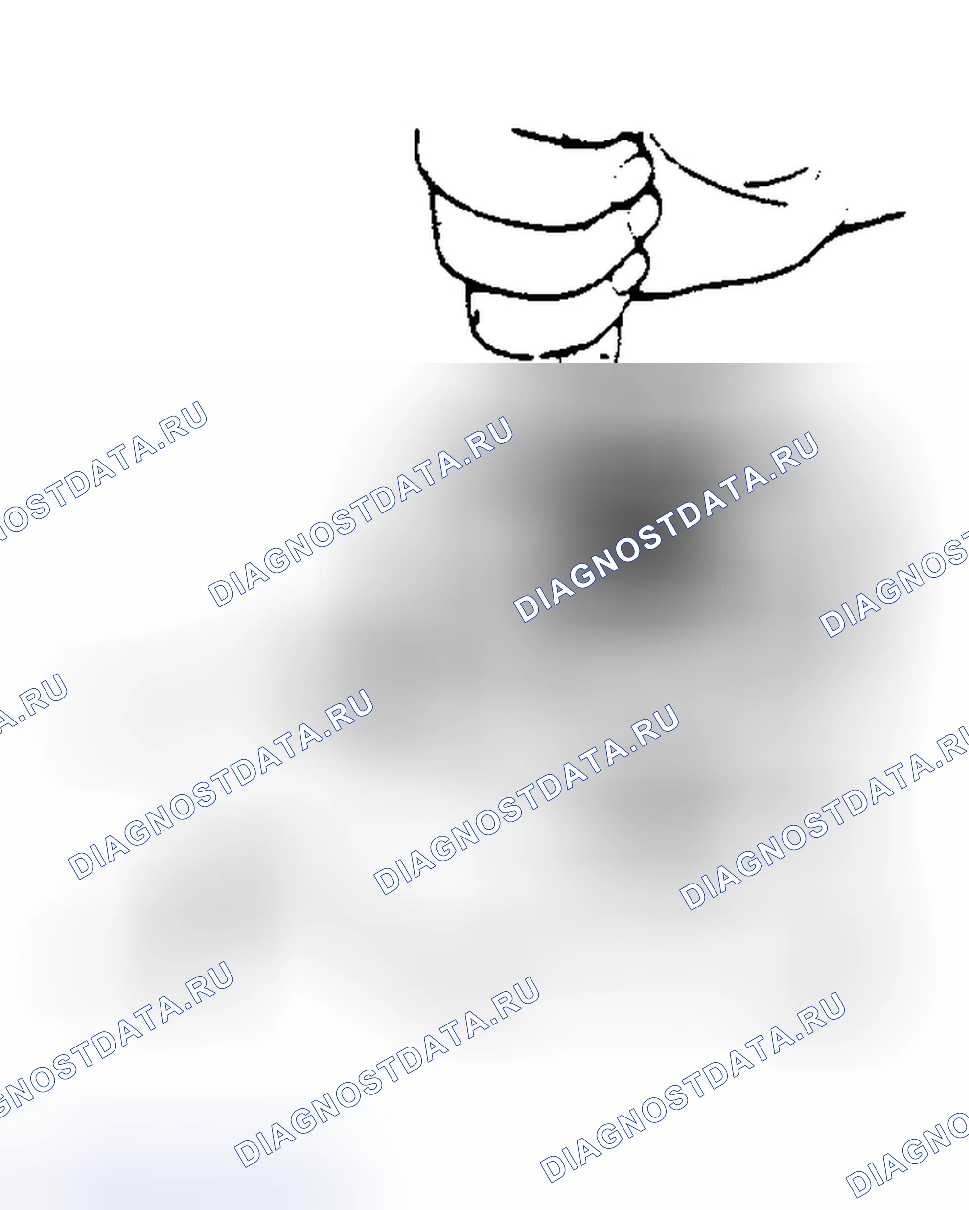 Рис. 79: Снятие стопорного кольца - инструмент № 5-Internal плоскогубцы для стопорного кольца. Buick Electra V