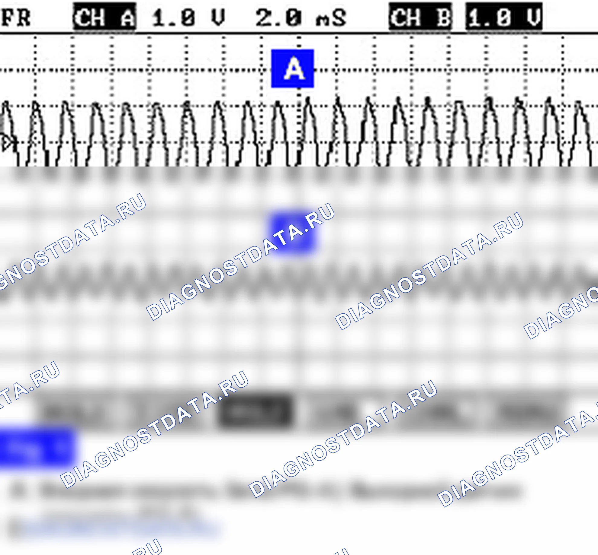 P0732: передача 2 неправильное передаточное отношение. Hyundai Accent LC